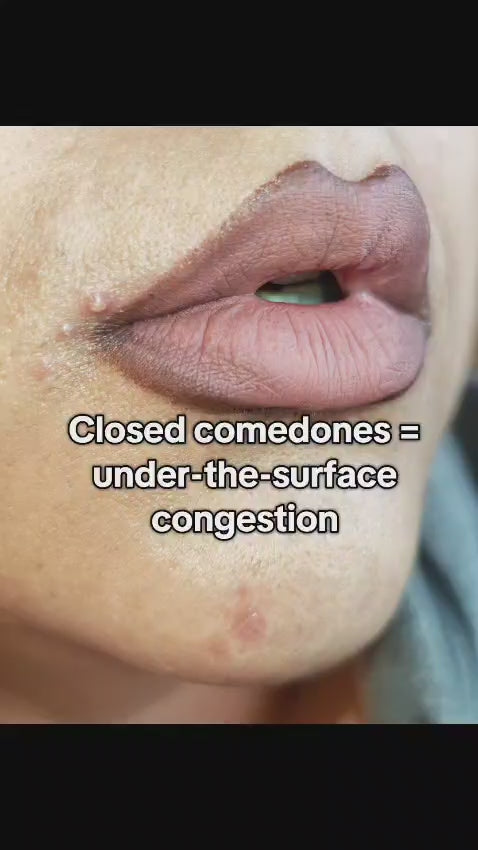 CLAYRITY Acne Spot Treatment